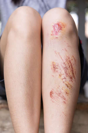 Bruise wound on woman's shin. Selective focus
