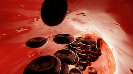 Atherosclerosis disease. blockage of blood flow from plague. 3d illustration