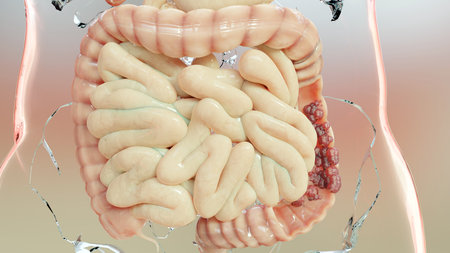 Bowel cancer or Colorectal tumor, Colon cancer, intestine inflammatory bowel Disease, intestine pain, celiac, infections, duplicating, cells expanding, malignant cancerous, virusesの写真素材