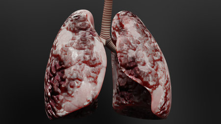 Pneumonia illness, healthy lungs and disease lungs, Human Lungs cancer, Cigarette smokers Lung disease, cancerous malignant tumor growing and spreading, respiratory system, asthmaの写真素材