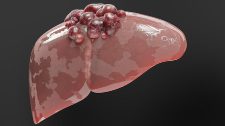 Digestive Organ Liver Cancer, Hepatitis cirrhosis malignant tumor, Hepatic failure, growing cells,...