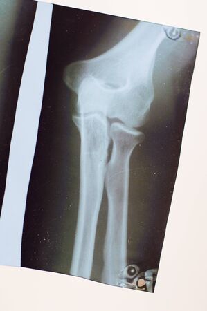 x-ray joint pictureの写真素材