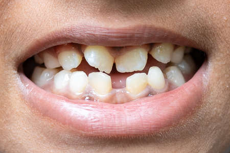 beautiful smile by press ceramic crown and vennersの写真素材