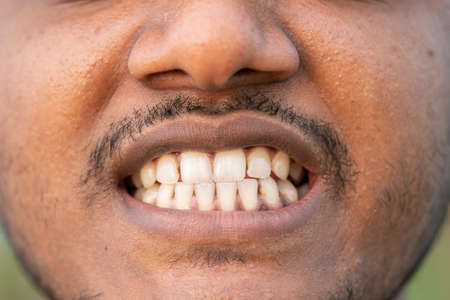 male patient mouth with tooth disease. hygiene and orthodontic problem.の写真素材