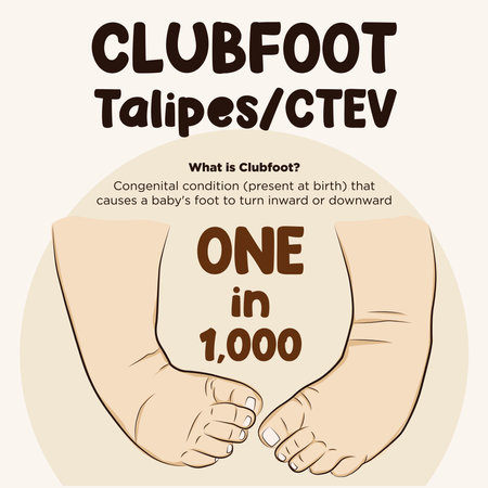 Line art vector of clubfoot. Foot turn inward or upward. Type of clubfoot, Talipes Varusのイラスト素材