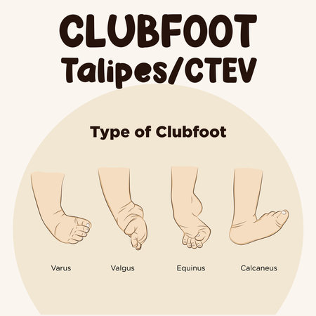 Vector types of clubfoot. Foot turn inward or upward. Type of clubfoot, Talipes Varus, Valgus, Equinus and Calcaneusのイラスト素材