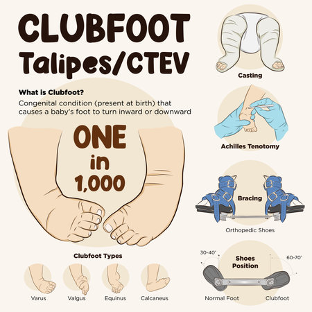 Vector of the process of clubfoot treatment. Ponseti Method. Clubfoot orthopaedic infographic.のイラスト素材