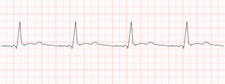 Black heart beat diagram on red graph paper. Electrocardiogram chart example. Cardiac rhythm line. Cardio test sign. Cardiology hospital symbolのイラスト素材
