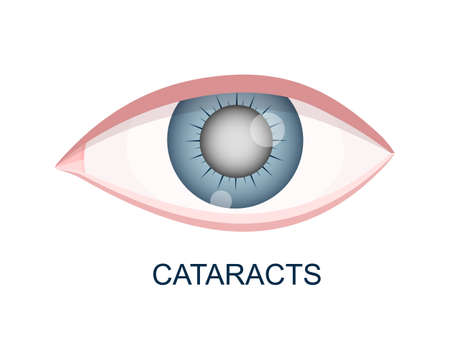 Cataract eye close up view. Eyeball with cloudy lens. Anatomically accurate human organ of vision with aging problems isolated on white background. Vector realistic illustration.のイラスト素材