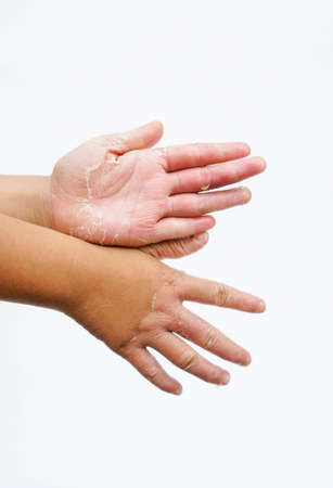 Dry hands peel, Contact dermatitis, fungal infections, Skin infections from exposureの写真素材