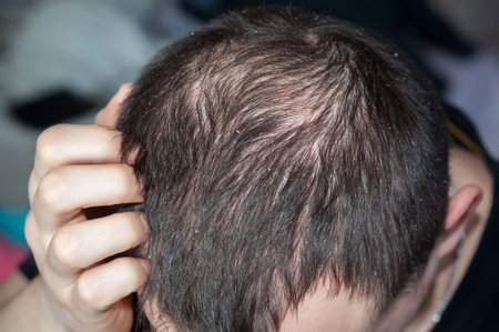 hair loss problem in a young man. hair loss problem. hair loss problem