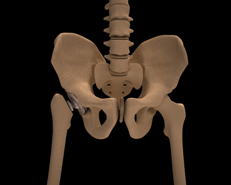 Human skeleton with a metal hip prosthesis concept arthroplasty 3d render isolated on a black backgroundの写真素材