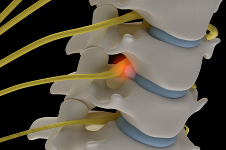 Anatomically accurate 3d image of cervical spine with prolapse of intervertebral disc compressive nerve root isolated on black backgroundの写真素材