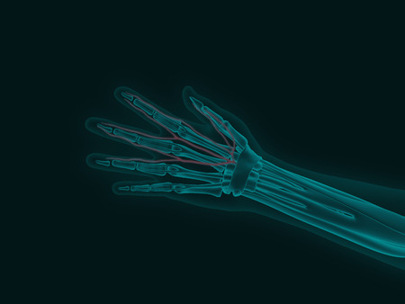 X-ray image of a human hand with carpal tunnel syndrome 3d render medical illustrationの写真素材