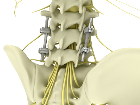 Metal pedicle screw fixation system with flexible rods in the lumbar spine isolated on white background 3d illustrationの写真素材