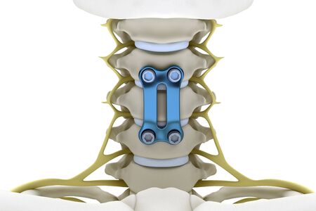 Cervical vertebrae fixed with a metal plate and screws isolated on a white background. 3d render image.の写真素材