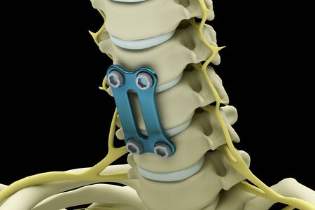 Cervical vertebrae fixed with a metal plate and screws isolated on a black background. 3d render illustration.の写真素材