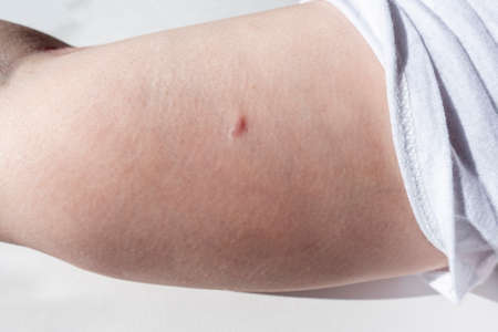 Close up view of a woman's birth control implant removal scar, several months after the device's...