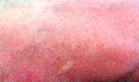 Very hard to sunburned skin