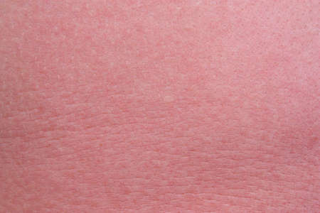 Strong sunburn skinの写真素材