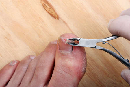 Surgery on a broken toe nail a manの写真素材