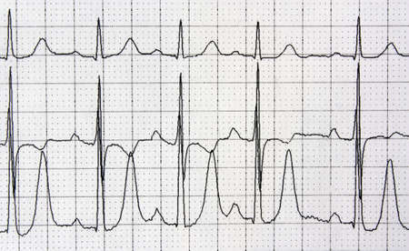 Detail of an electrocardiogram in paper  heart rhythm disease cardiology backgroundの写真素材