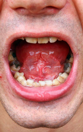 Outbreaks of tartar and amalgam fillingsの写真素材
