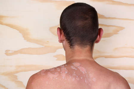 Sunburn back from a man and peeling skin