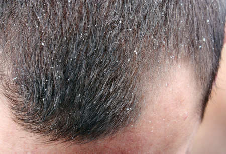 Dandruff in the hair. Symptoms of skin diseaseの写真素材