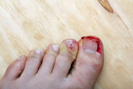 Surgery on a broken bleeding toe nail a man