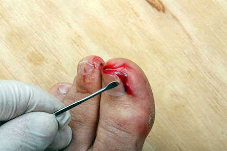 Surgery on a broken bleeding toe nail a manの写真素材