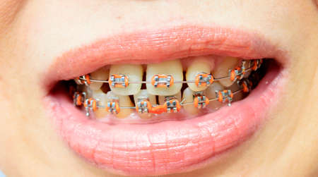 teeth with braces