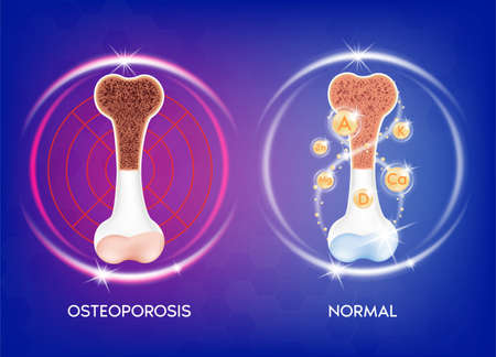 Realistic 3d bone Medical illustration healthy bone and unhealthy bone- osteoporosis. Medical or healthcare concept. bone protection.のイラスト素材