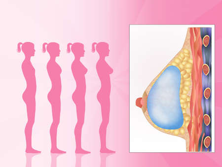 breast implantsの写真素材