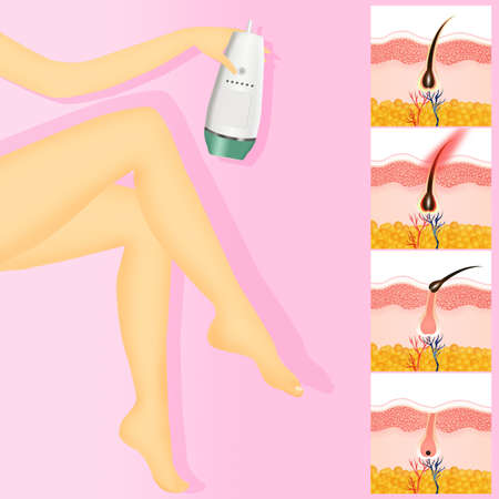 Permanent hair removalの写真素材