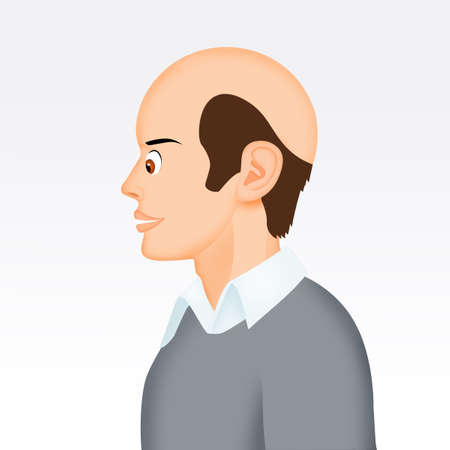 illustration of man with alopeciaの写真素材