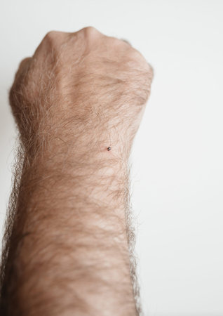 A male hand with a tick sucking blood on the skin, set against a white background, capturing the...