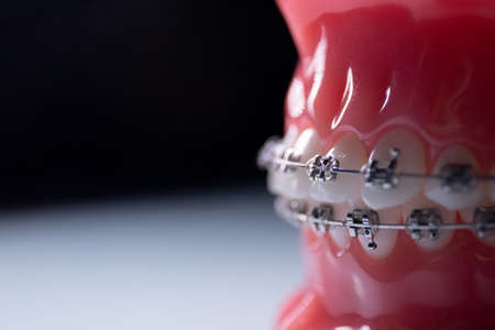 Close-up of teeth with metal braces. The jaw with braces turns on the surfaceの写真素材