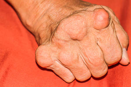 Severe gout in men suffering from joint pain, bone pain, gout, rheumatoid symptoms, radioactive sicknessの写真素材