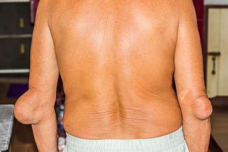Severe gout in men suffering from joint pain, bone pain, gout, rheumatoid symptoms, radioactive sicknessの写真素材