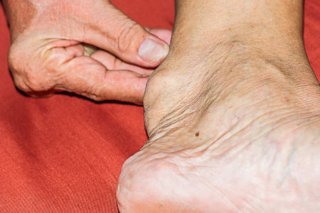 Severe gout in men suffering from joint pain, bone pain, gout, rheumatoid symptoms, radioactive sickness, ill man concept of male osteoporosis, injured bone, injury, pain, arthritis,arm, foot, kneeの写真素材
