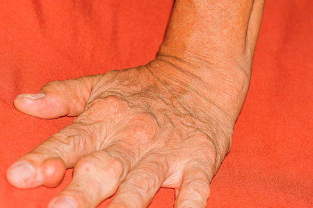 Severe gout in men suffering from joint pain, bone pain, gout, rheumatoid symptoms, radioactive sickness, ill man concept of male osteoporosis, injured bone, injury, pain, arthritis,arm, foot, kneeの写真素材