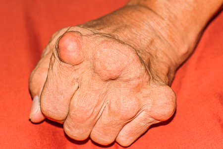 Severe gout in men suffering from joint pain, bone pain, gout, rheumatoid symptoms, radioactive sickness, ill man concept of male osteoporosis, injured bone, injury, pain, arthritis,arm, foot, kneeの写真素材