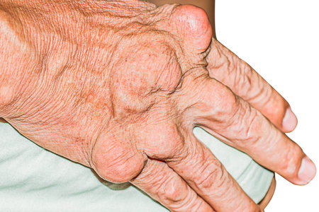 Severe gout in men suffering from joint pain, bone pain, gout, rheumatoid symptoms, radioactive sickness, ill man concept of male osteoporosis, injured bone, injury, pain, arthritis,arm, foot, kneeの写真素材