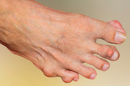 Severe gout in men suffering from joint pain, bone pain, gout, rheumatoid symptoms, radioactive...