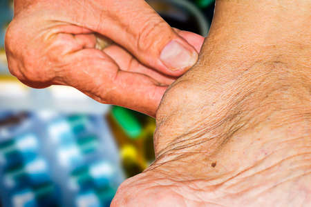 Severe gout in men suffering from joint pain, bone pain, gout, rheumatoid symptoms, radioactive sickness, ill man concept of male osteoporosis, injured bone, injury, pain, arthritis,arm, foot, kneeの写真素材