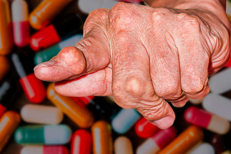 Severe gout in men suffering from joint pain, bone pain, gout, rheumatoid symptoms, radioactive sickness, ill man concept of male osteoporosis, injured bone, injury, pain, arthritis,arm, foot, kneeの写真素材