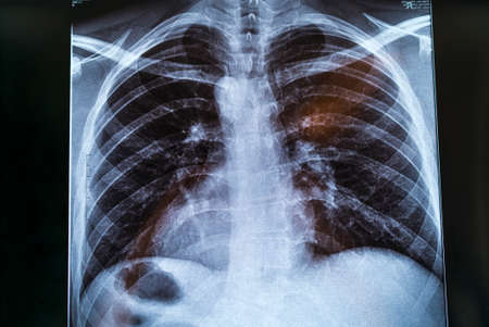 Chest X-ray image for physician's examinationの写真素材