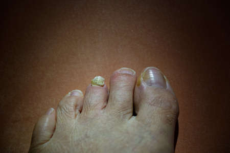 A toe nail barely hangs on to the base of the toe - ouchの写真素材