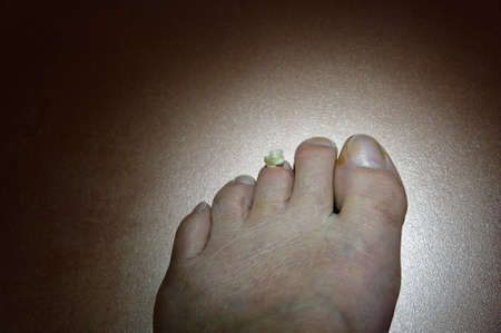 An unloved foot has a toe with a toenail ripped offの写真素材